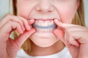 8 Braces Simulators for Previewing Metal, Ceramic, and Clear Aligners
